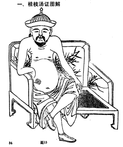 檔案:桂枝湯腹證.png