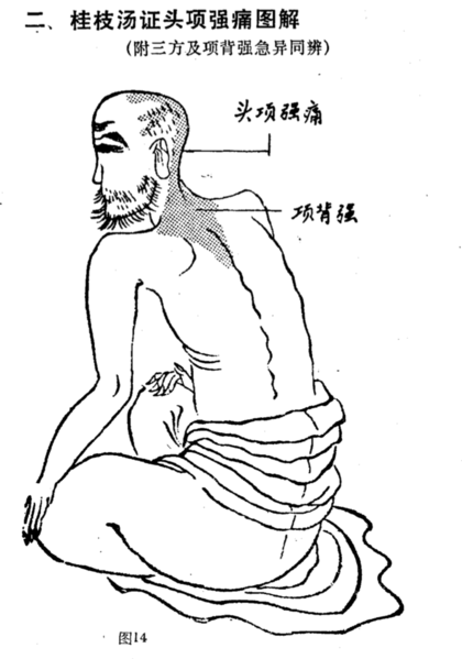 檔案:桂枝湯頭項證.png