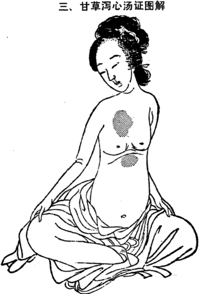 檔案:甘草瀉心湯腹證.png